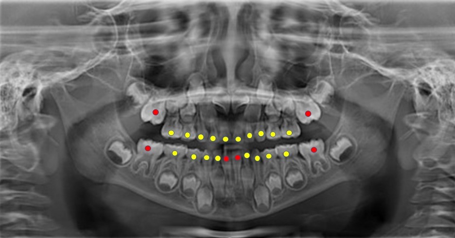 این تصویر موقعیت دندانهای آسیاب اول دائم را نشان می دهد.