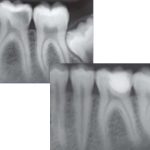 دندانهایی با پوسیدگی وسیع معمولا نیاز به عصب کشی پیدا می کنند. اما با دانش، تشخیص و مهارت کافی، امکان آن هست که همانند تصویر بالا، برخی از آنها را بتوان بدون عصب کشی ترمیم کرد.